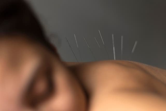 Acupuncture femme